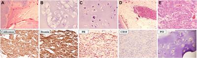 A case report of recurrent leiomyosarcoma with chondrosarcoma differentiation in the abdominal wall and a review of the literature